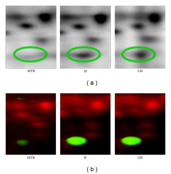 Cathepsin D Expression in Colorectal Cancer: From Proteomic Discovery through Validation Using Western Blotting, Immunohistochemistry, and Tissue Microarrays.