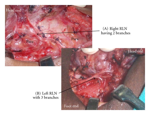 A Closer Look at Laryngeal Nerves during Thyroid Surgery: A Descriptive Study of 584 Nerves.