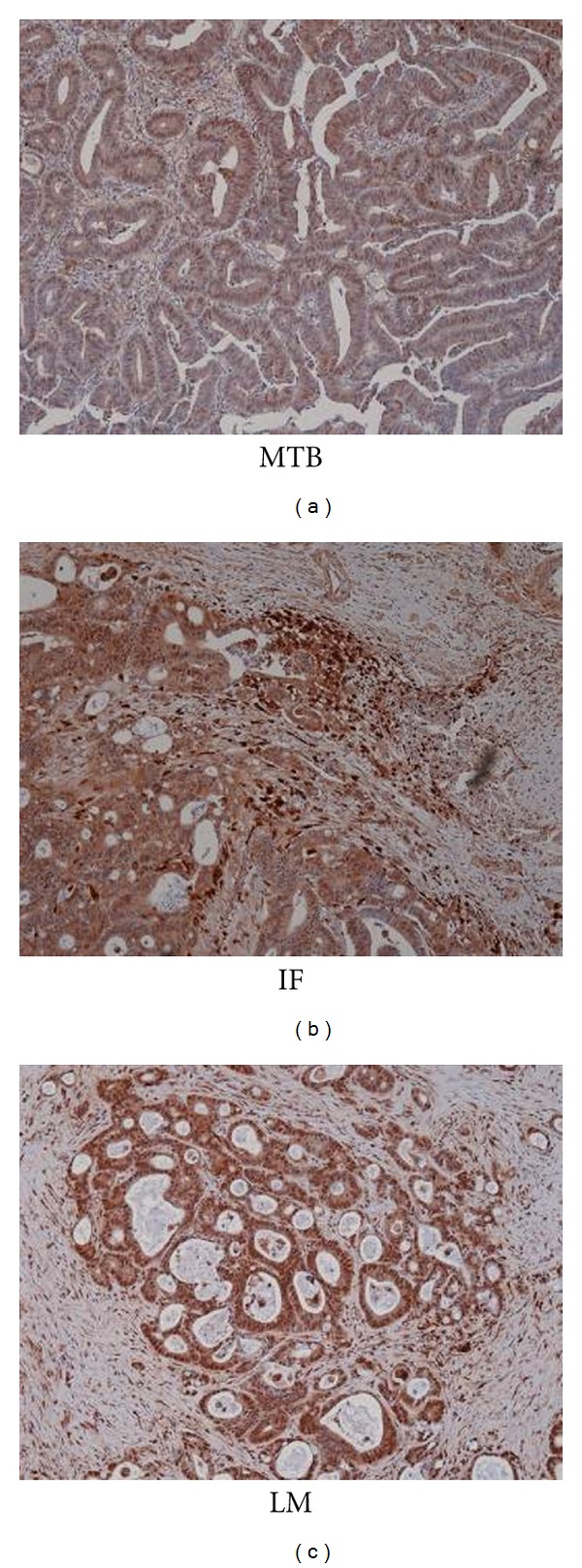 Cathepsin D Expression in Colorectal Cancer: From Proteomic Discovery through Validation Using Western Blotting, Immunohistochemistry, and Tissue Microarrays.