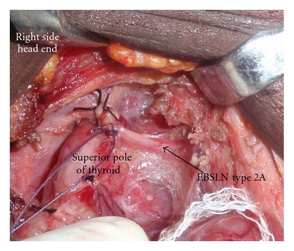 A Closer Look at Laryngeal Nerves during Thyroid Surgery: A Descriptive Study of 584 Nerves.