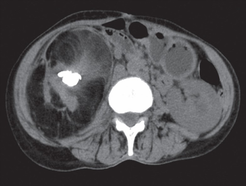 Renal replacement lipomatosis.