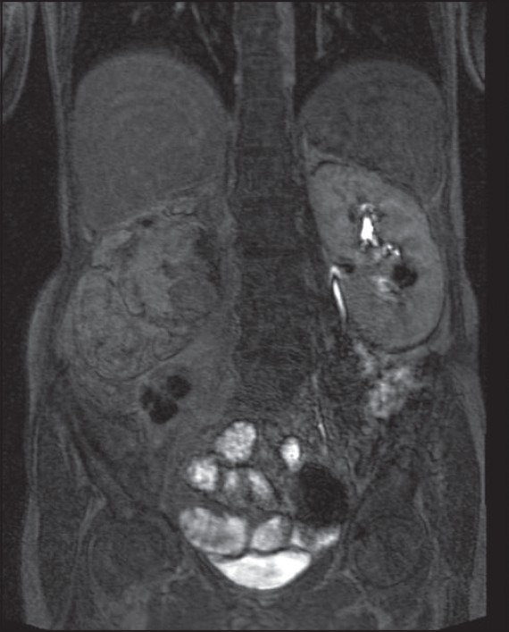 Renal replacement lipomatosis.