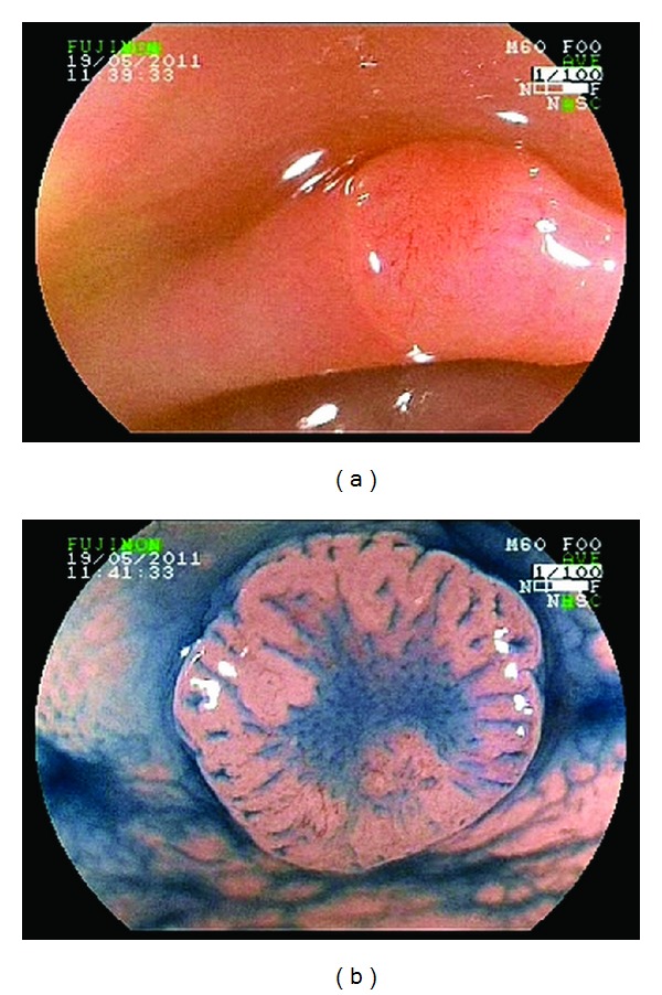 Digital chromoendoscopy for diagnosis of diminutive colorectal lesions.