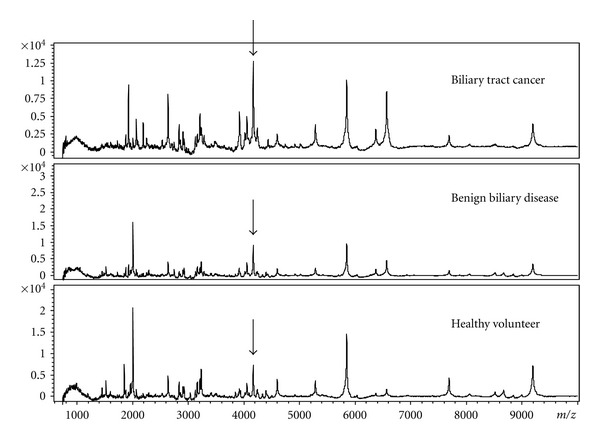 Identification of a Novel Biomarker for Biliary Tract Cancer Using Matrix-Assisted Laser Desorption/Ionization Time-of-Flight Mass Spectrometry.