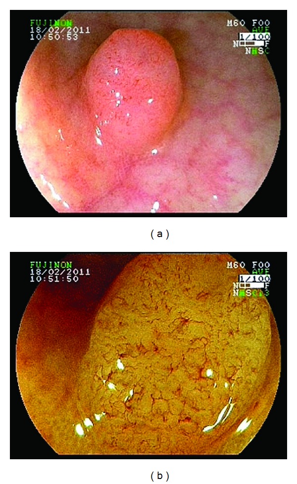 Digital chromoendoscopy for diagnosis of diminutive colorectal lesions.