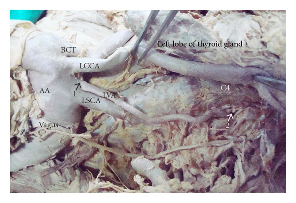 Bilateral variation in the origin and course of the vertebral artery.
