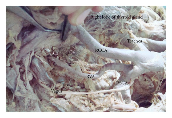 Bilateral variation in the origin and course of the vertebral artery.