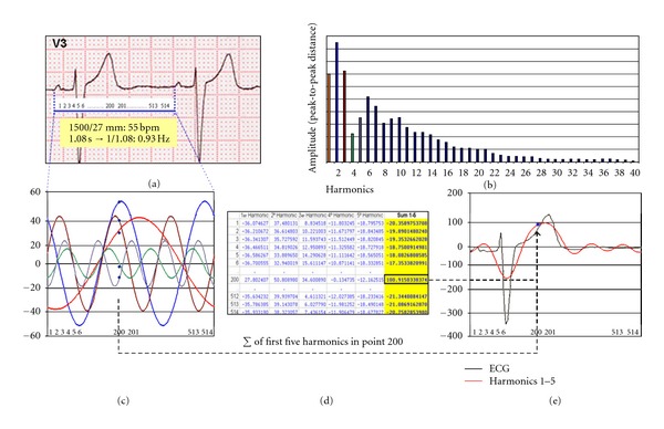 High-Bandpass Filters in Electrocardiography: Source of Error in the Interpretation of the ST Segment.