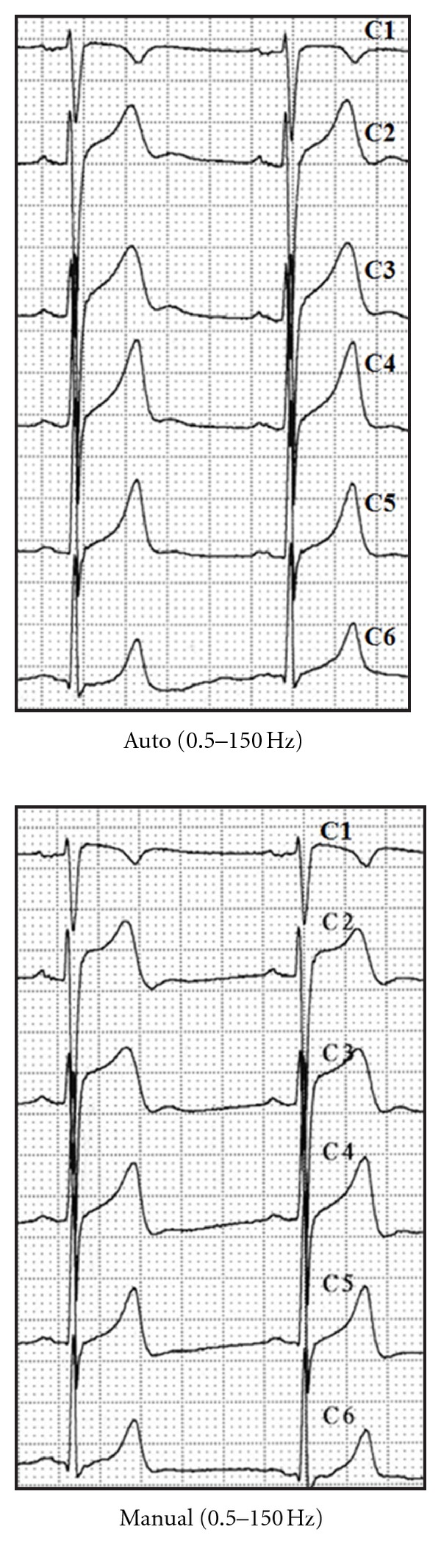 High-Bandpass Filters in Electrocardiography: Source of Error in the Interpretation of the ST Segment.