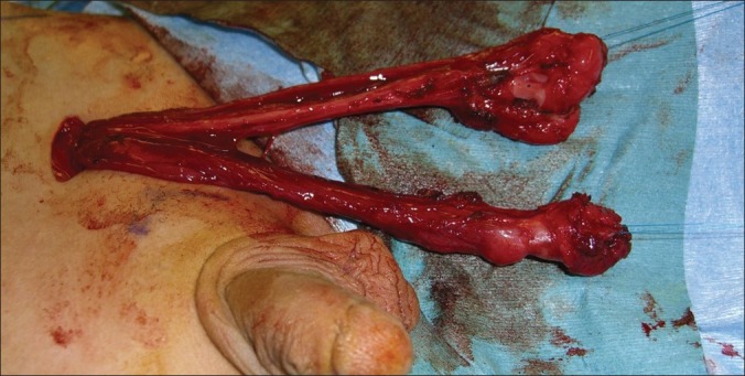 Transverse testicular ectopia with disorders of sex development.
