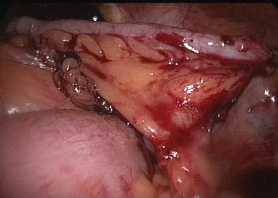 Laparoscopic mitrofanoff appendicovesicostomy: Our experience in children.