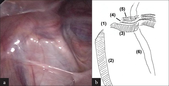 Transverse testicular ectopia with disorders of sex development.