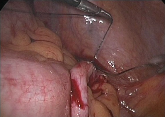 Laparoscopic mitrofanoff appendicovesicostomy: Our experience in children.