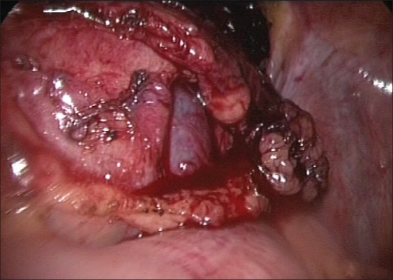 Laparoscopic mitrofanoff appendicovesicostomy: Our experience in children.