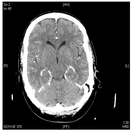 Posterior reversible encephalopathy syndrome mimicking a left middle cerebral artery stroke.