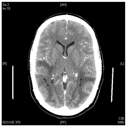 Posterior reversible encephalopathy syndrome mimicking a left middle cerebral artery stroke.