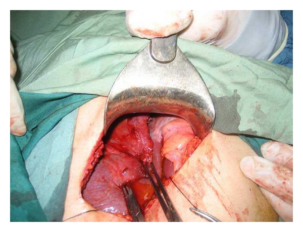 Vest-over-Pant Method for Closure of Residual Cavity of Liver Hydatid Cyst.