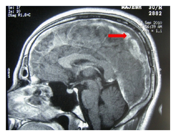 Cerebral vein thrombosis misdiagnosed and mismanaged.