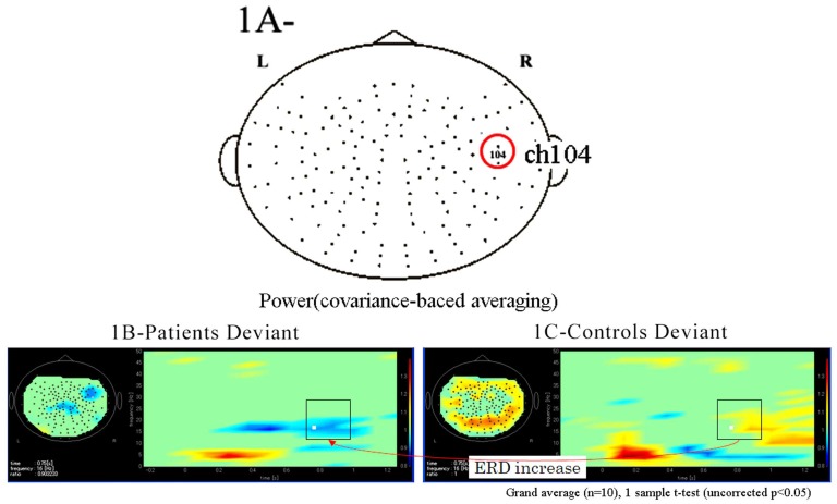 Changes in Event-Related Desynchronization and Synchronization during the Auditory Oddball Task in Schizophrenia Patients.