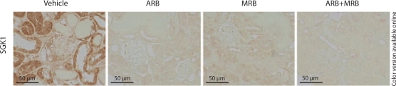 Mineralocorticoid Receptor Blocker Protects against Podocyte-Dependent Glomerulosclerosis.