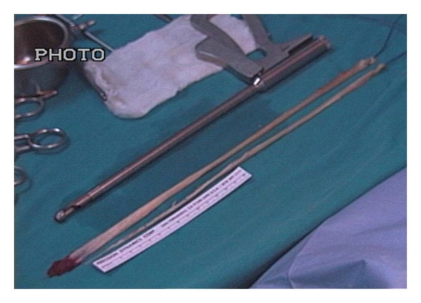 Adequacy of semitendinosus tendon alone for anterior cruciate ligament reconstruction graft and prediction of hamstring graft size by evaluating simple anthropometric parameters.