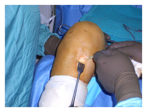 Adequacy of semitendinosus tendon alone for anterior cruciate ligament reconstruction graft and prediction of hamstring graft size by evaluating simple anthropometric parameters.