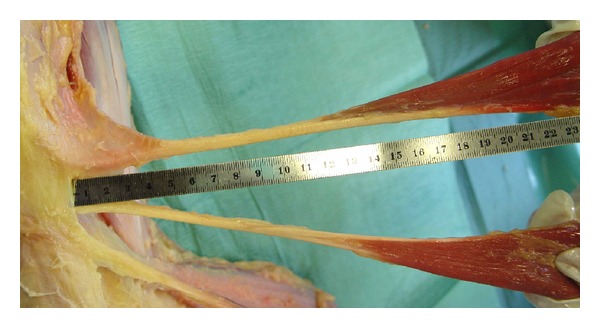 Adequacy of semitendinosus tendon alone for anterior cruciate ligament reconstruction graft and prediction of hamstring graft size by evaluating simple anthropometric parameters.