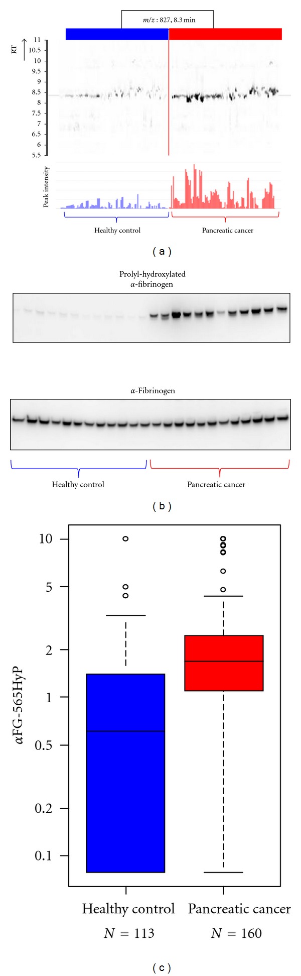 Biomarker Discovery of Pancreatic and Gastrointestinal Cancer by 2DICAL: 2-Dimensional Image-Converted Analysis of Liquid Chromatography and Mass Spectrometry.