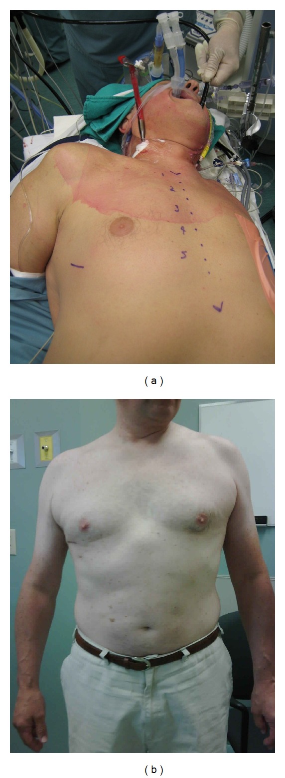 Minimally invasive surgical therapies for atrial fibrillation.