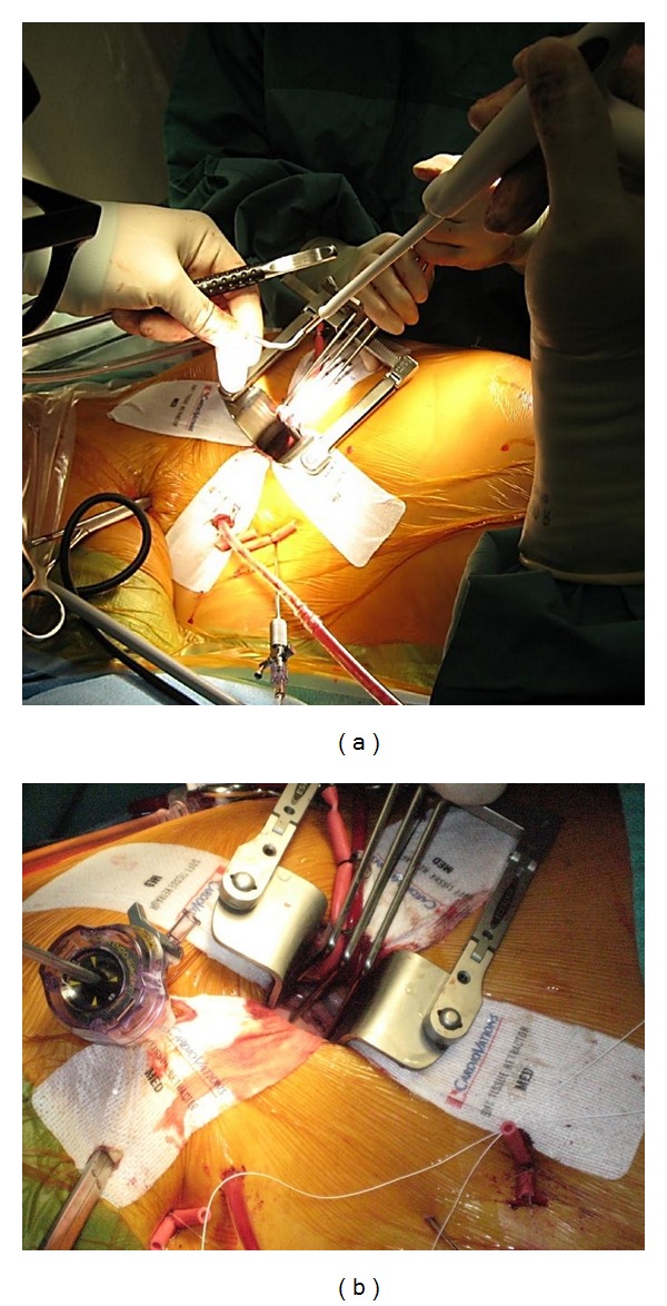 Minimally invasive surgical therapies for atrial fibrillation.
