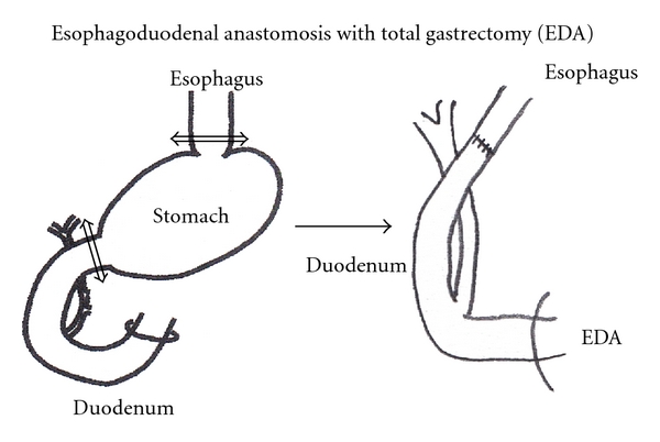 Expression of COX2 and p53 in Rat Esophageal Cancer Induced by Reflux of Duodenal Contents.