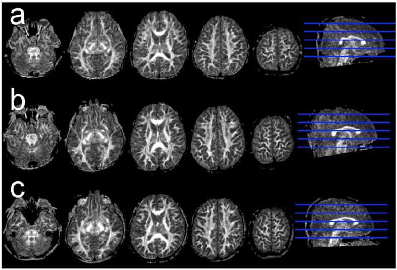 Brain development in childhood.