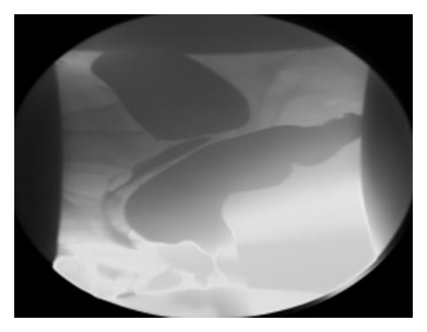 Stapled transanal rectal resection for the surgical treatment of obstructed defecation syndrome associated with rectocele and rectal intussusception.