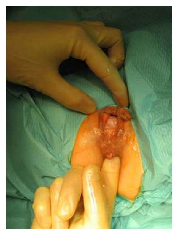 Stapled transanal rectal resection for the surgical treatment of obstructed defecation syndrome associated with rectocele and rectal intussusception.
