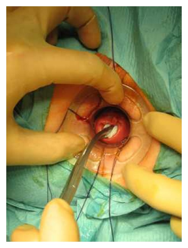 Stapled transanal rectal resection for the surgical treatment of obstructed defecation syndrome associated with rectocele and rectal intussusception.