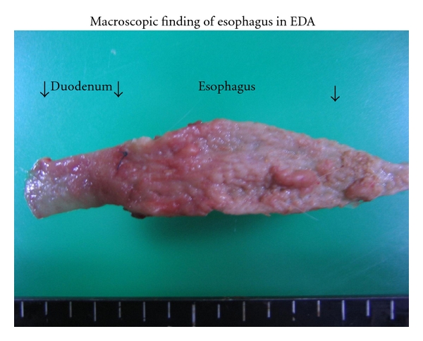 Expression of COX2 and p53 in Rat Esophageal Cancer Induced by Reflux of Duodenal Contents.
