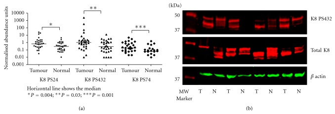 Increased Phospho-Keratin 8 Isoforms in Colorectal Tumors Associated with EGFR Pathway Activation and Reduced Apoptosis.