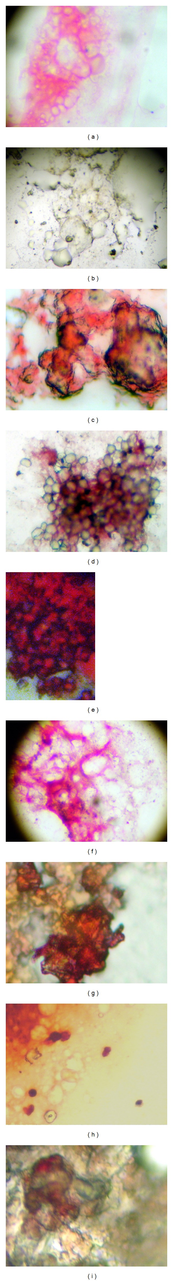 Differential expression of matrix metalloproteinase-2 expression in disseminated tumor cells and micrometastasis in bone marrow of patients with nonmetastatic and metastatic prostate cancer: theoretical considerations and clinical implications-an immunocytochemical study.