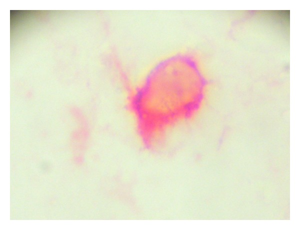 Differential expression of matrix metalloproteinase-2 expression in disseminated tumor cells and micrometastasis in bone marrow of patients with nonmetastatic and metastatic prostate cancer: theoretical considerations and clinical implications-an immunocytochemical study.