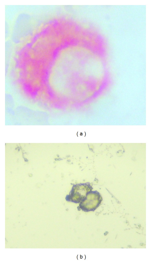 Differential expression of matrix metalloproteinase-2 expression in disseminated tumor cells and micrometastasis in bone marrow of patients with nonmetastatic and metastatic prostate cancer: theoretical considerations and clinical implications-an immunocytochemical study.