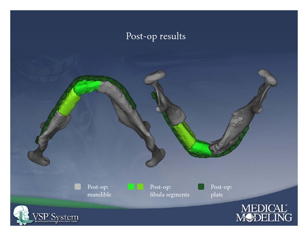 Free microsurgical and pedicled flaps for oncological mandibular reconstruction: technical aspects and evaluation of patient comorbidities.
