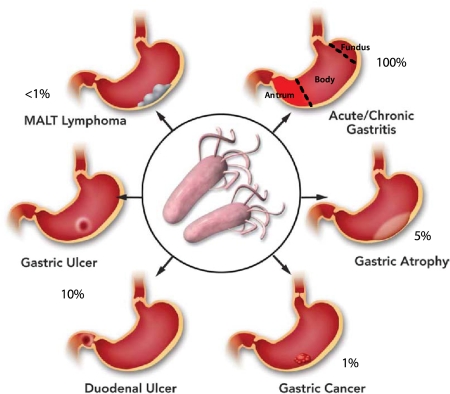 Helicobacter pylori: Eradication or Preservation.