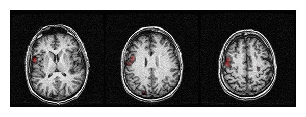 Functional magnetic resonance imaging for language mapping in temporal lobe epilepsy.