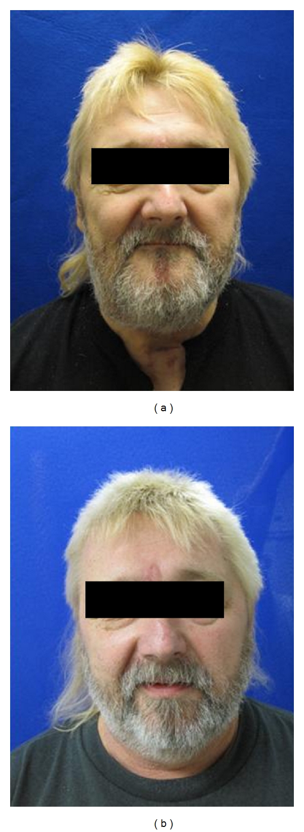 Free microsurgical and pedicled flaps for oncological mandibular reconstruction: technical aspects and evaluation of patient comorbidities.