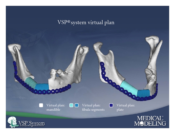 Free microsurgical and pedicled flaps for oncological mandibular reconstruction: technical aspects and evaluation of patient comorbidities.