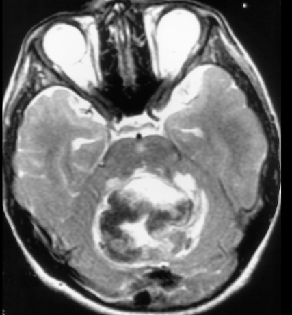 Pediatric cerebellar hemorrhagic glioblastoma multiforme.