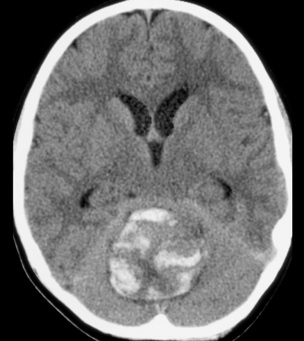 Pediatric cerebellar hemorrhagic glioblastoma multiforme.