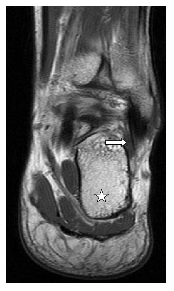 Analysis on the incidence of the fibularis quartus muscle using magnetic resonance imaging.
