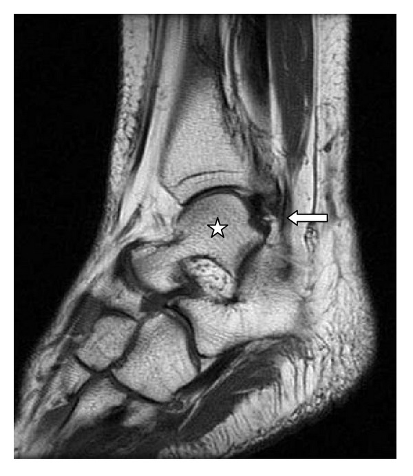 Analysis on the incidence of the fibularis quartus muscle using magnetic resonance imaging.