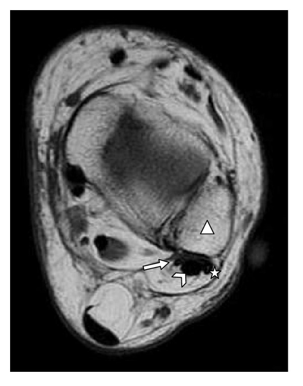 Analysis on the incidence of the fibularis quartus muscle using magnetic resonance imaging.